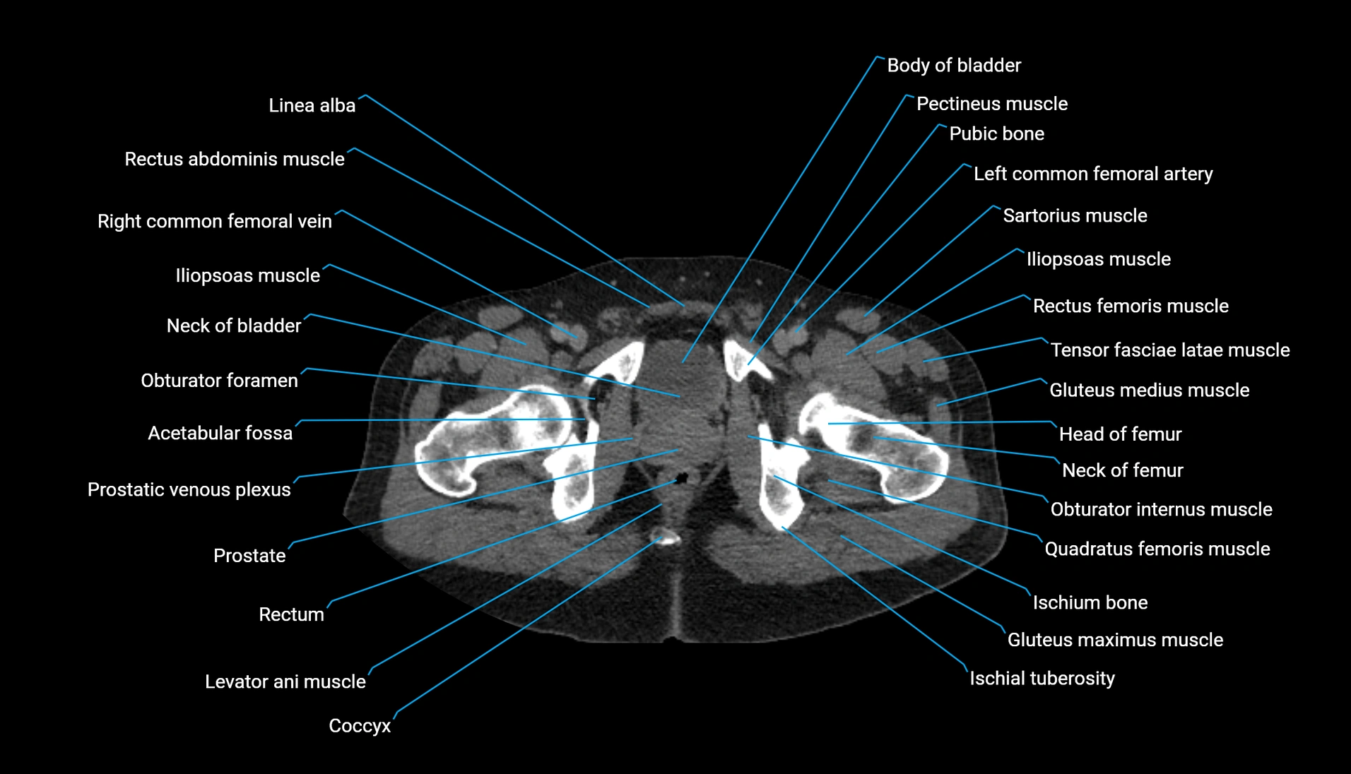 CT urogram axial cross sectional anatomy  labelled radiology image-00245.webp